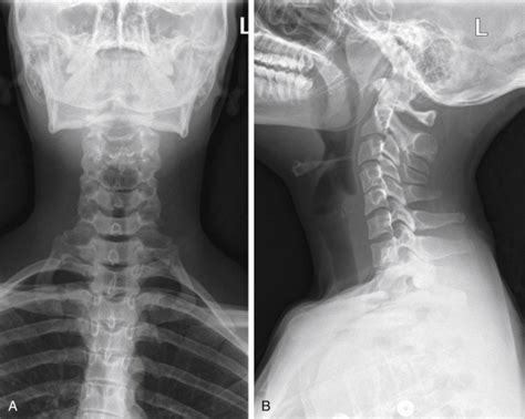 normal soft tissue neck x-ray|soft tissue neck x ray positioning.